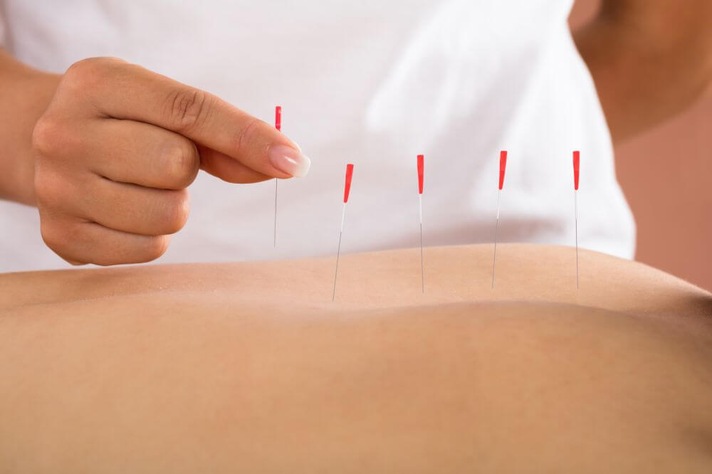 Akupunktura: na czym polega i jakie ma zastosowanie?